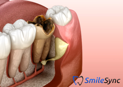 Dental Abscess