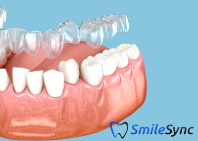 Clear Aligners (Invisalign)