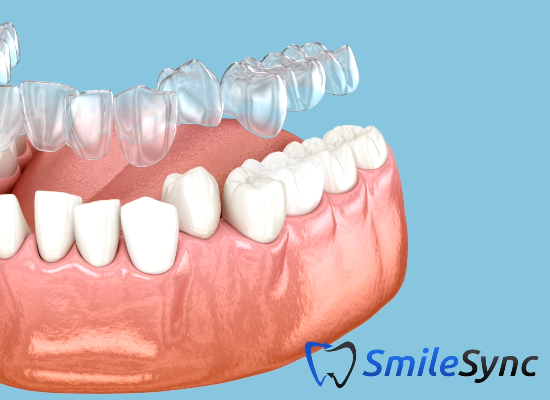 Clear Aligners (Invisalign)