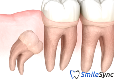 Impacted Teeth