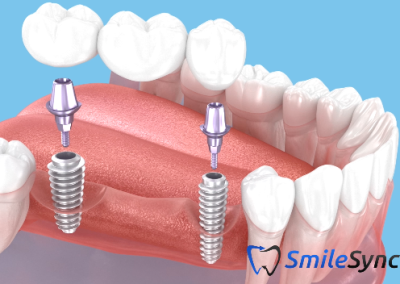 Implant Bridge