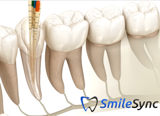 Root Canal Treatment