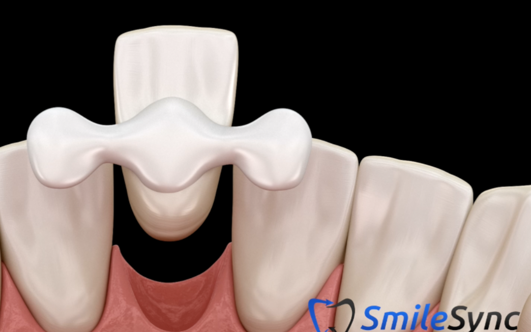 Maryland (Resin Retained) Bridge