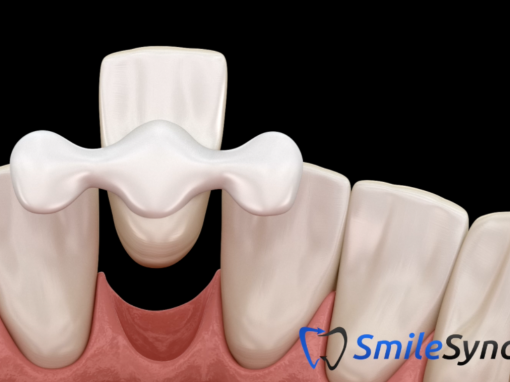 Maryland (Resin Retained) Bridge