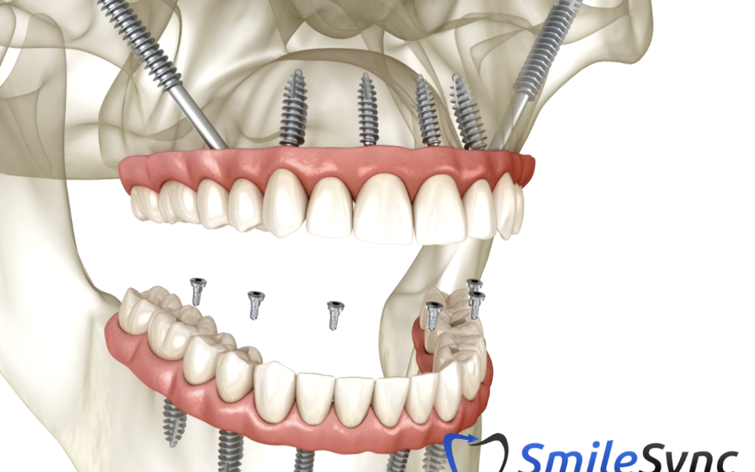 Zygomatic Implants
