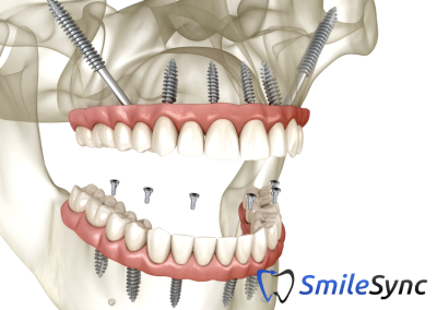 Zygomatic Implants