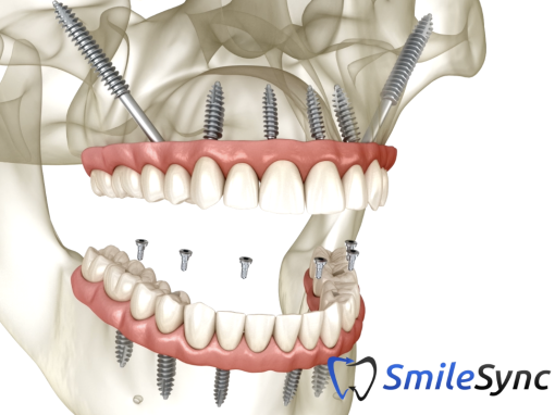 Zygomatic Implants