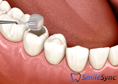 Composite Filling