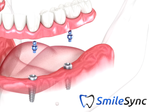 Implant Overdentures