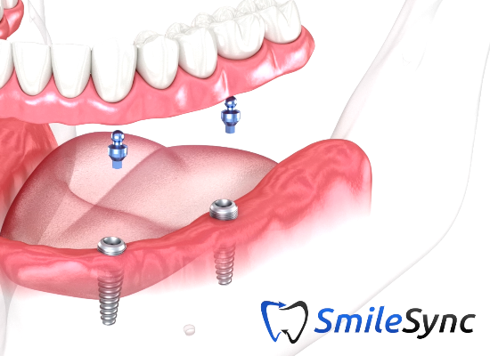 Implant Overdentures