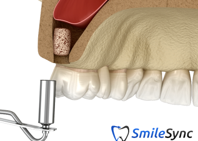 Internal Sinus Lift