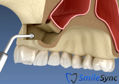 Lateral Window Sinus Lift