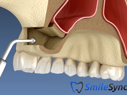 Lateral Window Sinus Lift