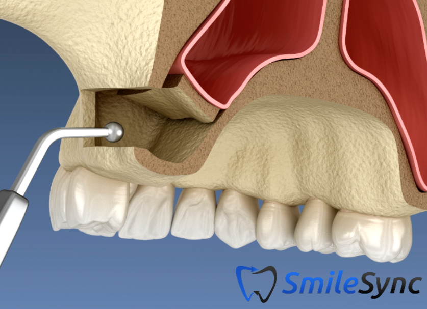 Lateral Window Sinus Lift