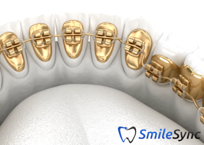 Lingual Braces