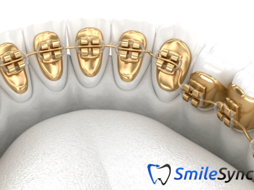 Lingual Braces