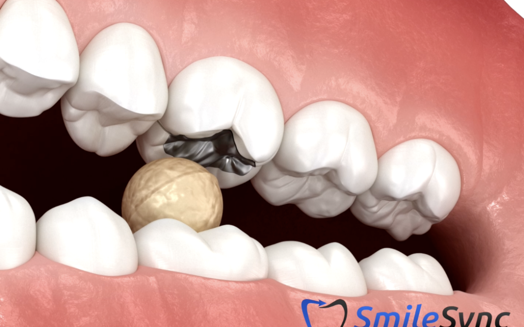 Cracked Tooth Syndrome