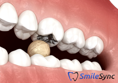 Cracked Tooth Syndrome
