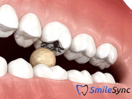 Cracked Tooth Syndrome